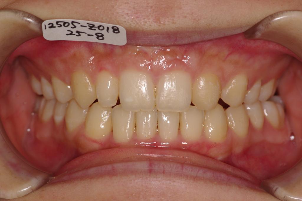 歯欠損の矯正治療後口内写真NO.80