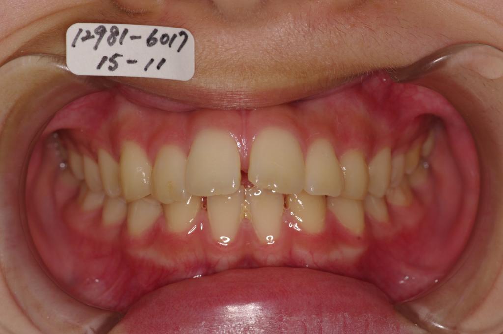 歯欠損の矯正治療前口内写真NO.81