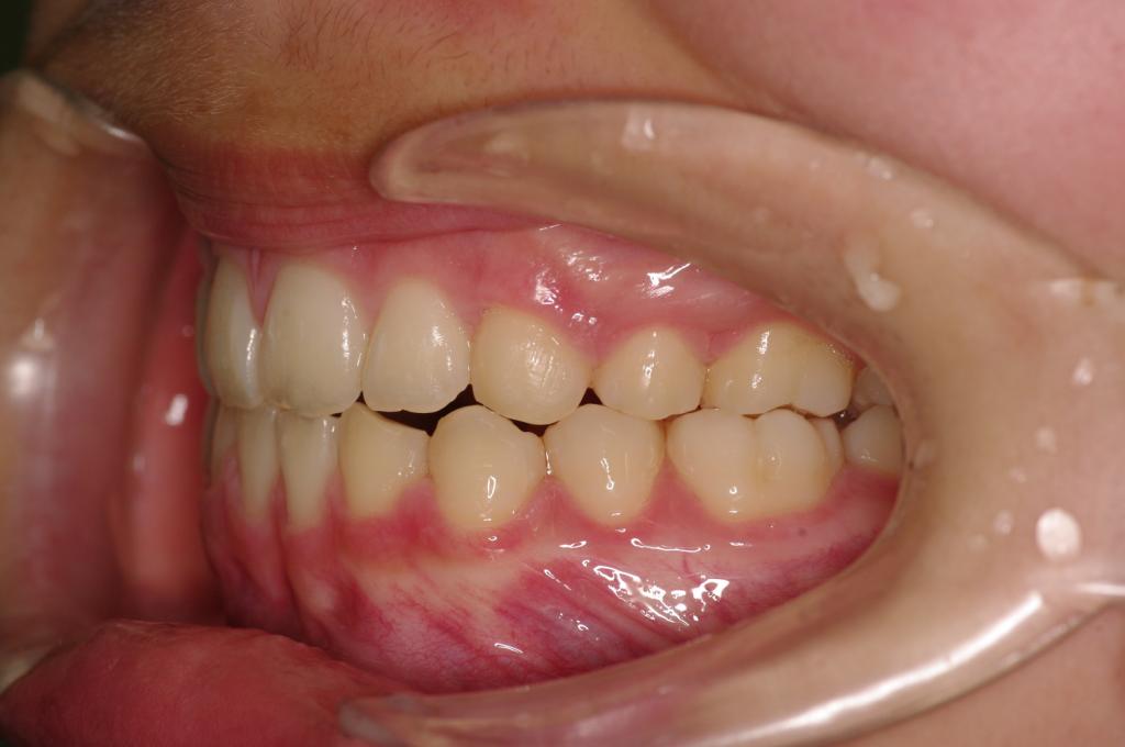 歯欠損の矯正治療後口内写真NO.81