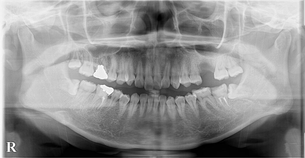 歯欠損の矯正治療前口内写真NO.82