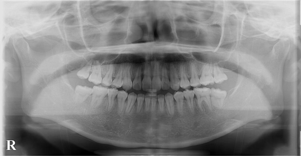 歯欠損の矯正治療後口内写真NO.82