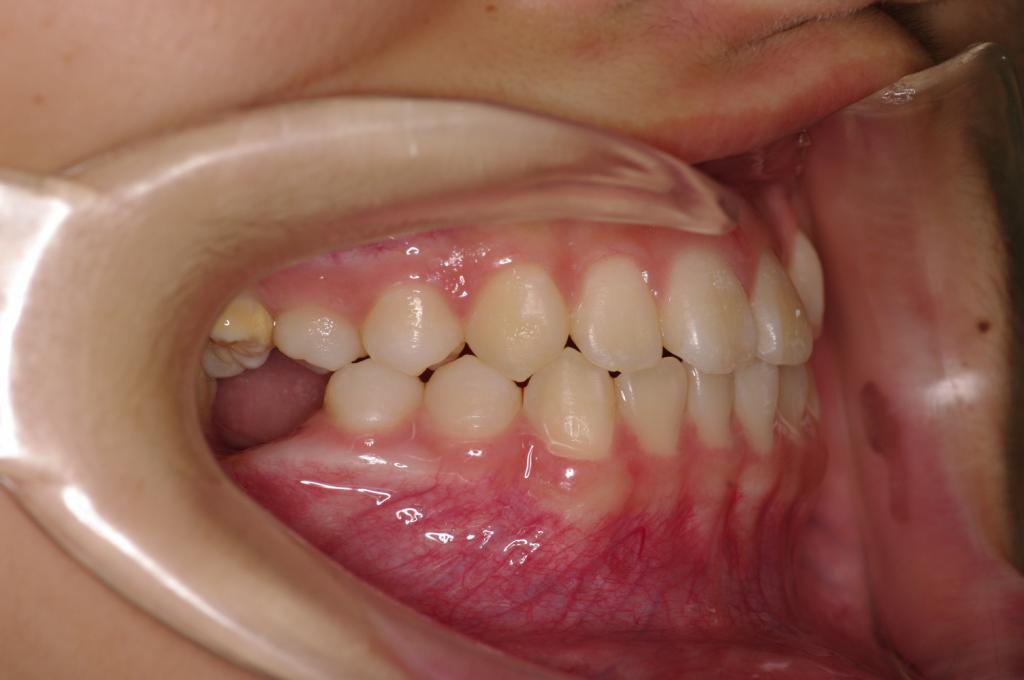 歯欠損の矯正治療前口内写真NO.83