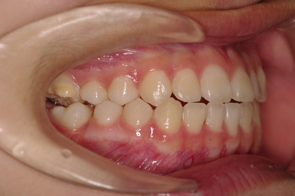 歯欠損の矯正治療後口内写真NO.83