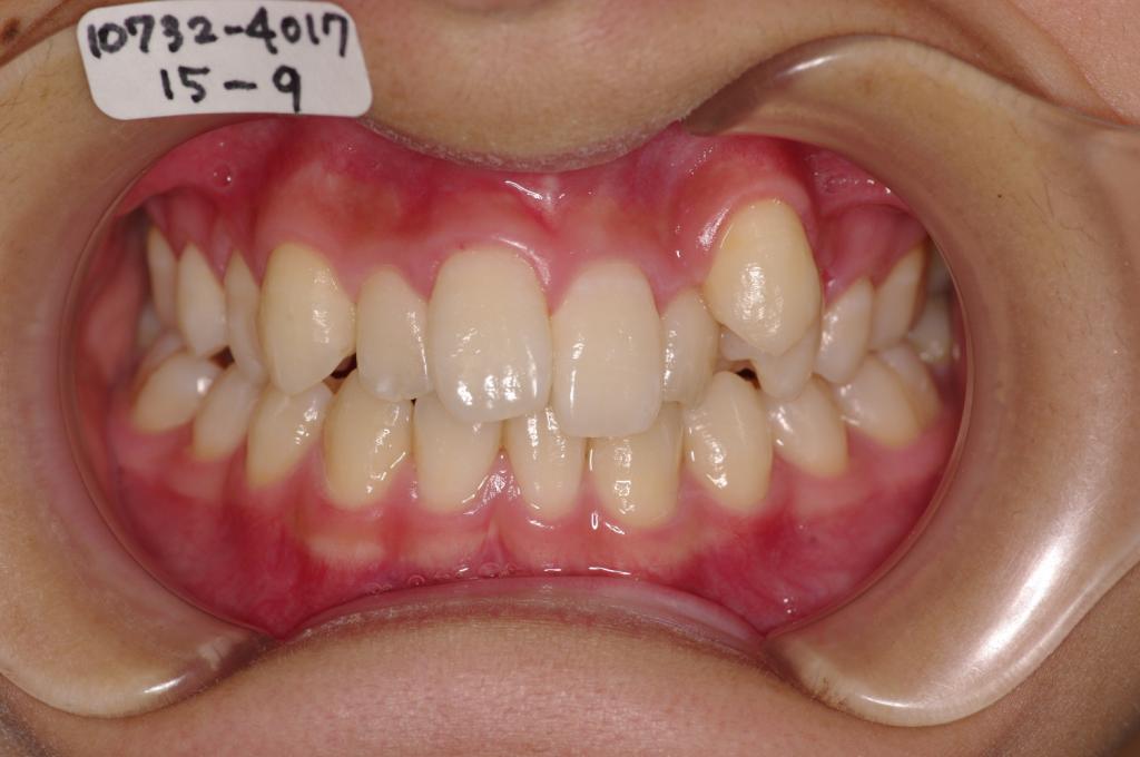 歯欠損の矯正治療前口内写真NO.84