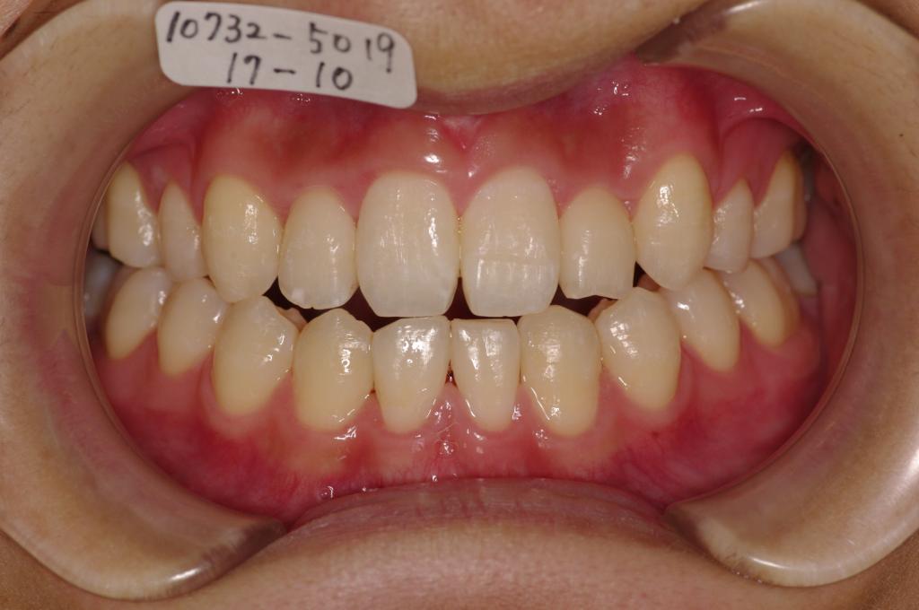 歯欠損の矯正治療後口内写真NO.84