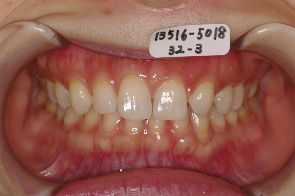 歯欠損の矯正治療前口内写真NO.85
