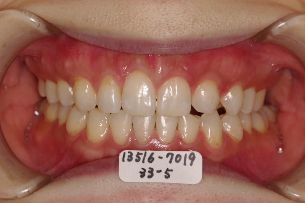 歯欠損の矯正治療後口内写真NO.85