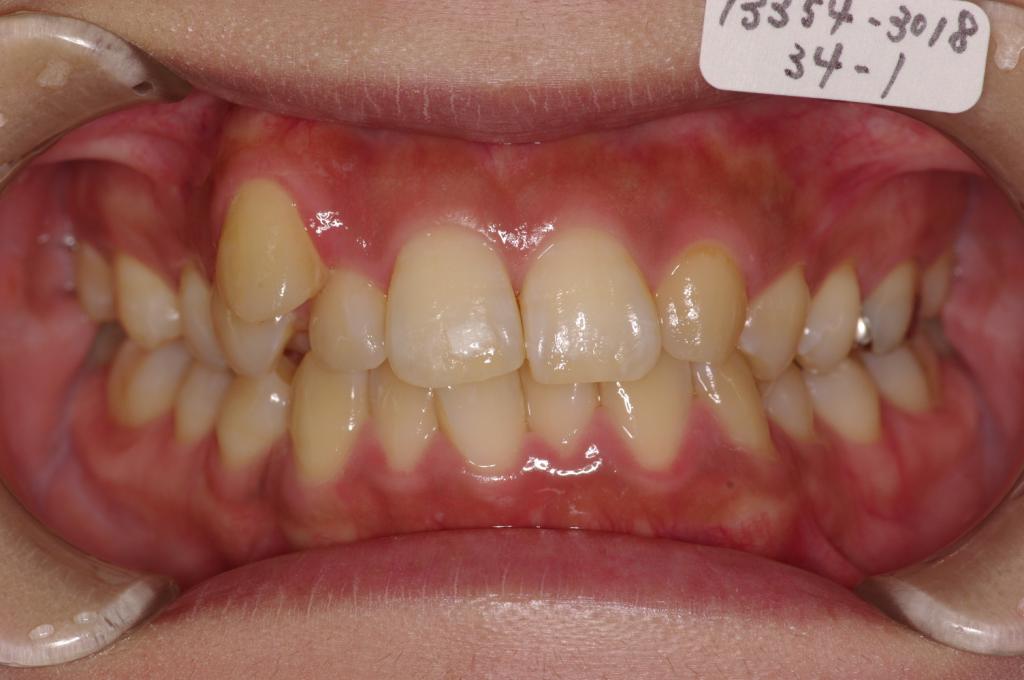 歯欠損の矯正治療前口内写真NO.86