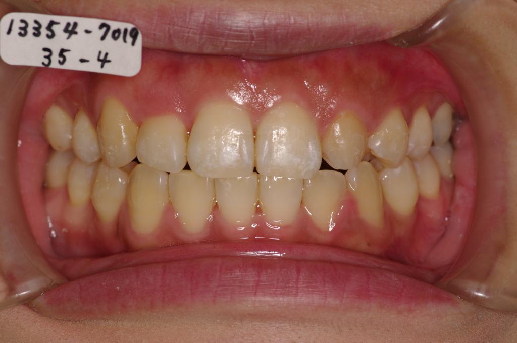 歯欠損の矯正治療後口内写真NO.86