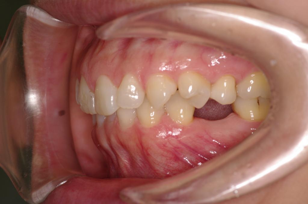 歯欠損の矯正治療前口内写真NO.87