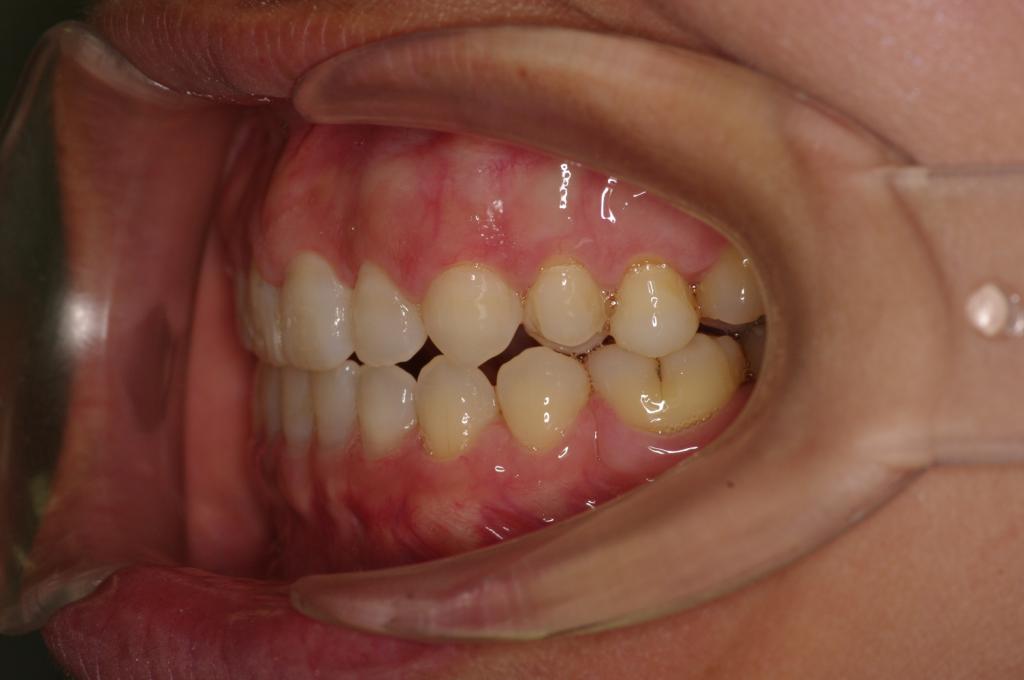 歯欠損の矯正治療後口内写真NO.87