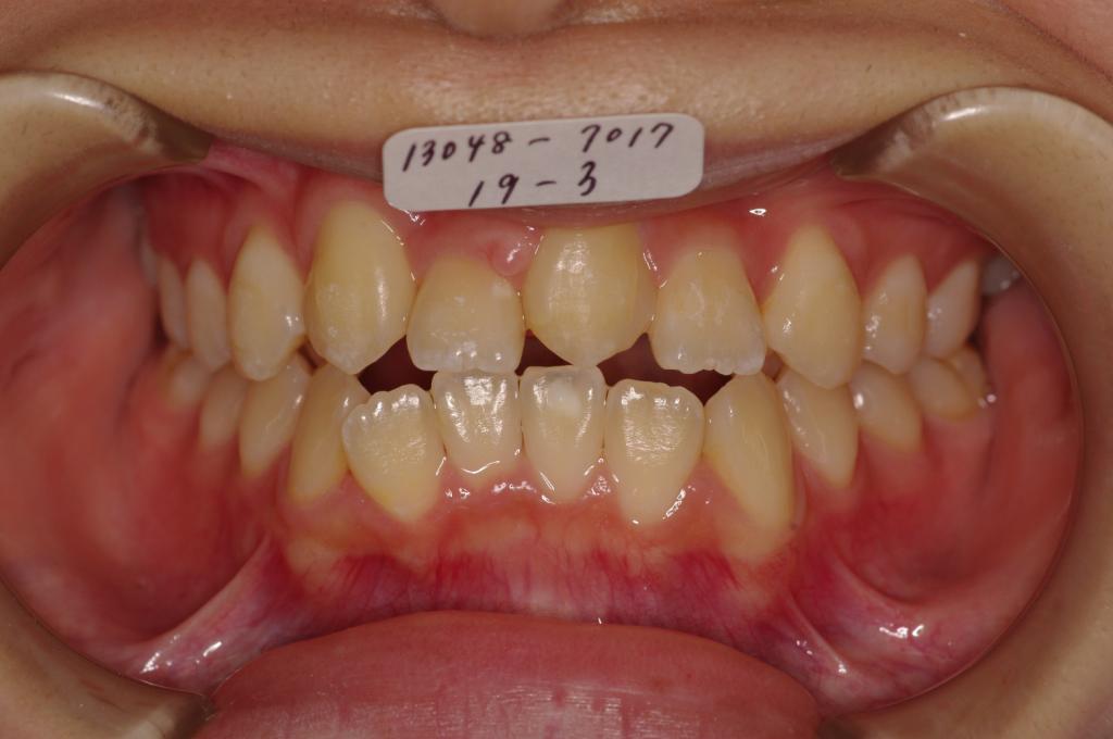 歯欠損の矯正治療前口内写真NO.88