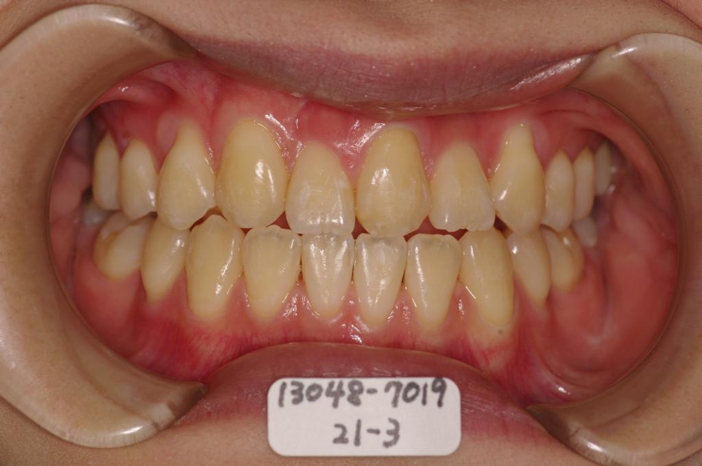 歯欠損の矯正治療後口内写真NO.88