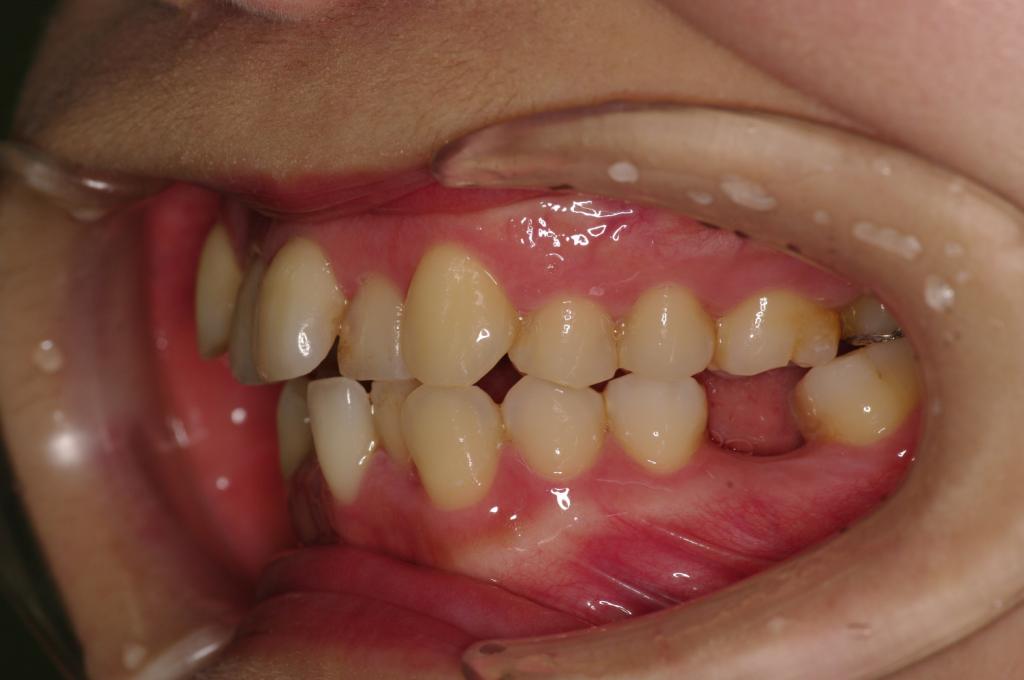 歯欠損の矯正治療前口内写真NO.89