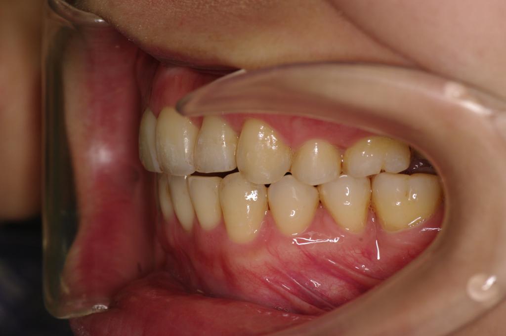 歯欠損の矯正治療後口内写真NO.89