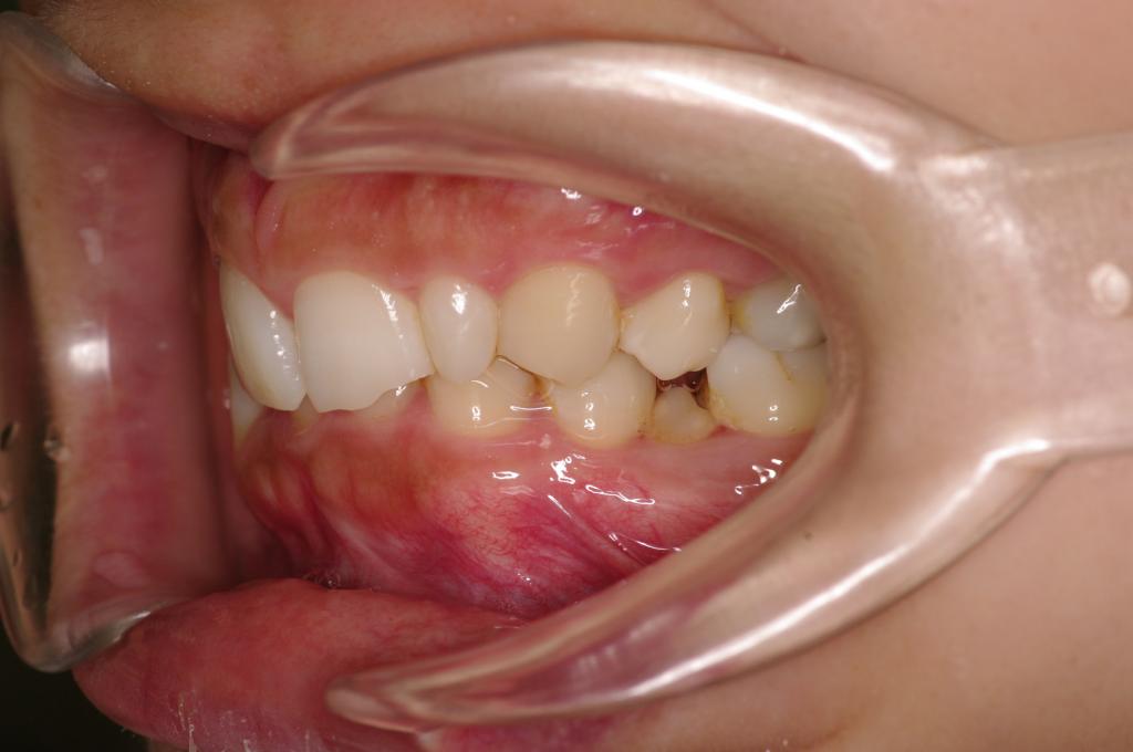 歯欠損の矯正治療前口内写真NO.90