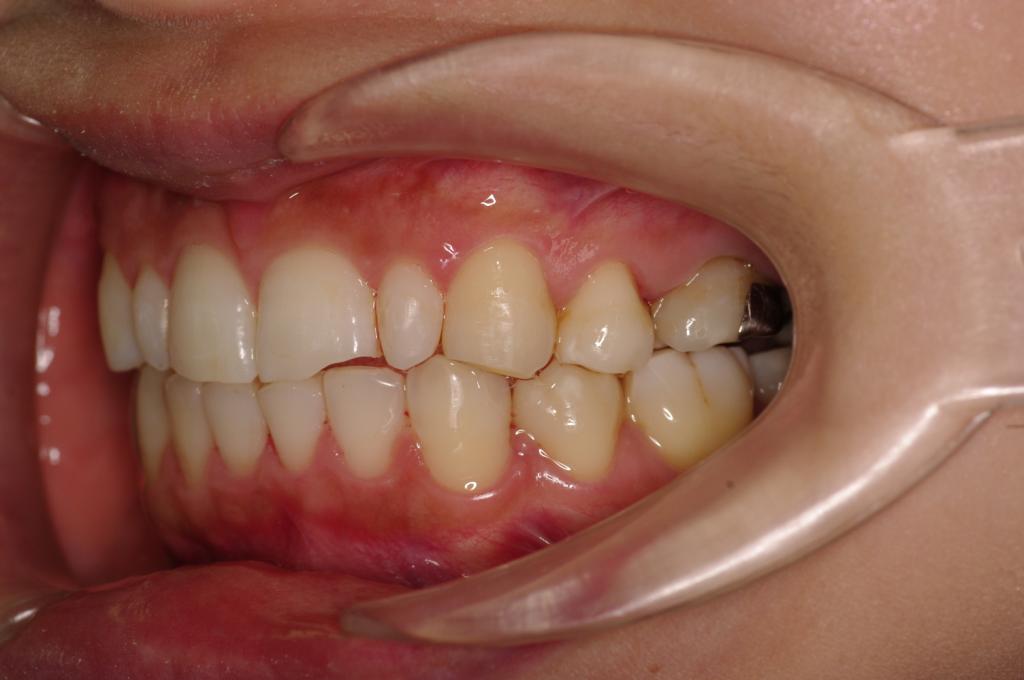 歯欠損の矯正治療後口内写真NO.90