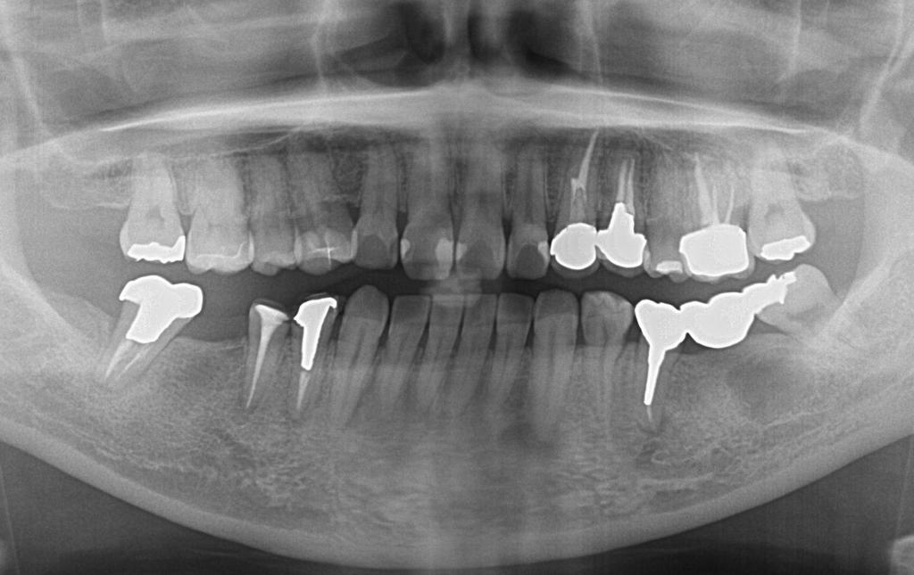 歯欠損の矯正治療前口内写真NO.91