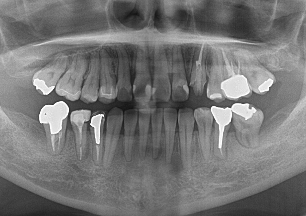 歯欠損の矯正治療後口内写真NO.91