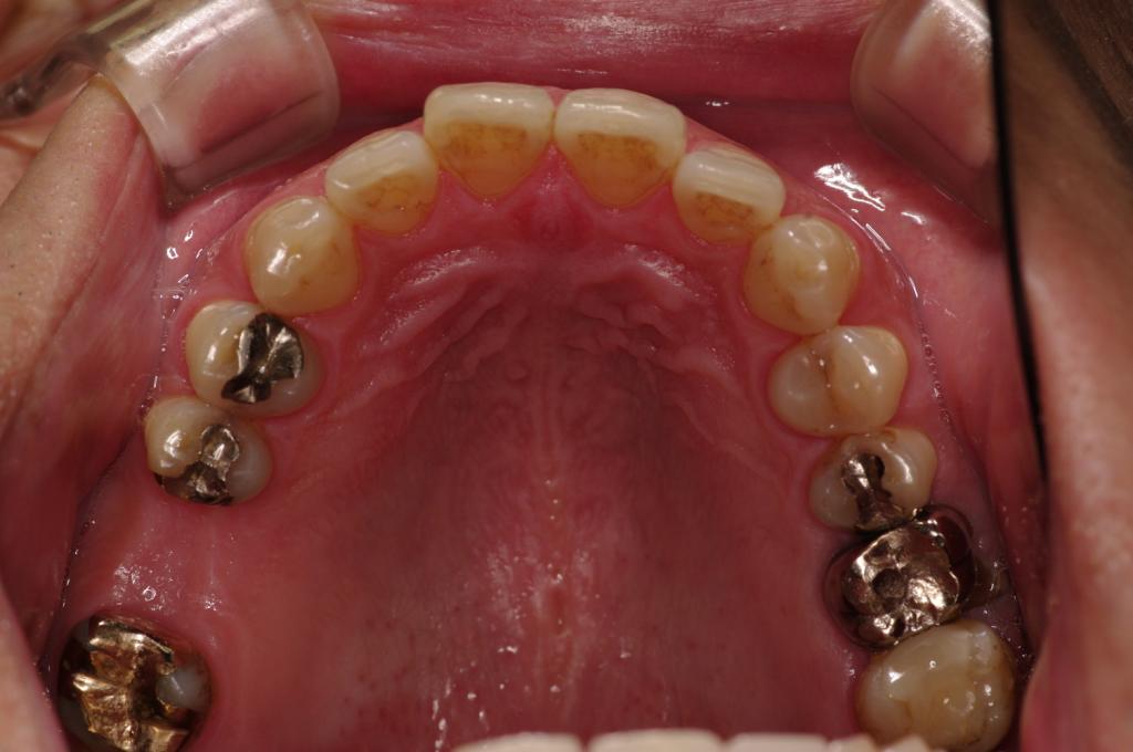 歯欠損の矯正治療前口内写真NO.92