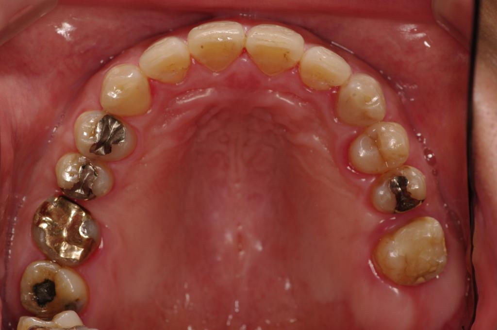 歯欠損の矯正治療後口内写真NO.92
