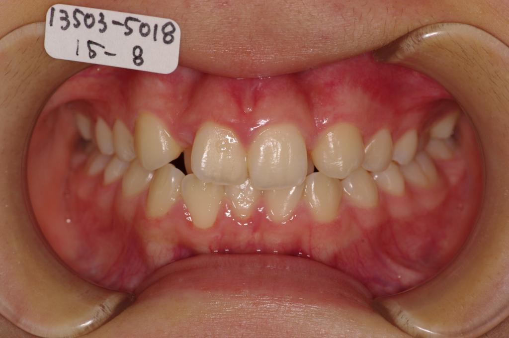 歯欠損の矯正治療前口内写真NO.93