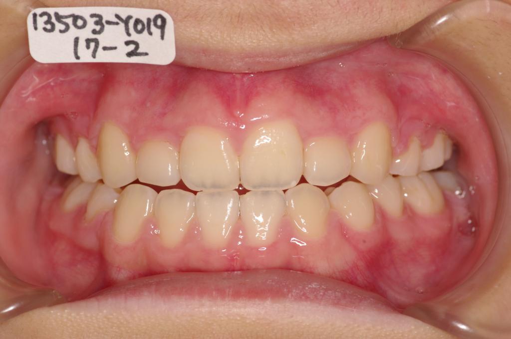 歯欠損の矯正治療後口内写真NO.93