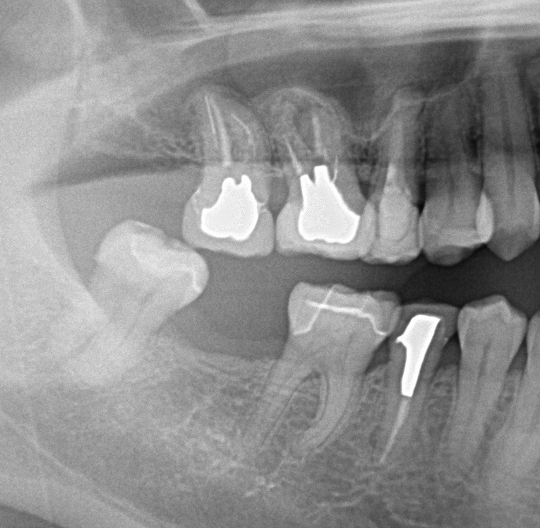 歯欠損の矯正治療前口内写真NO.94