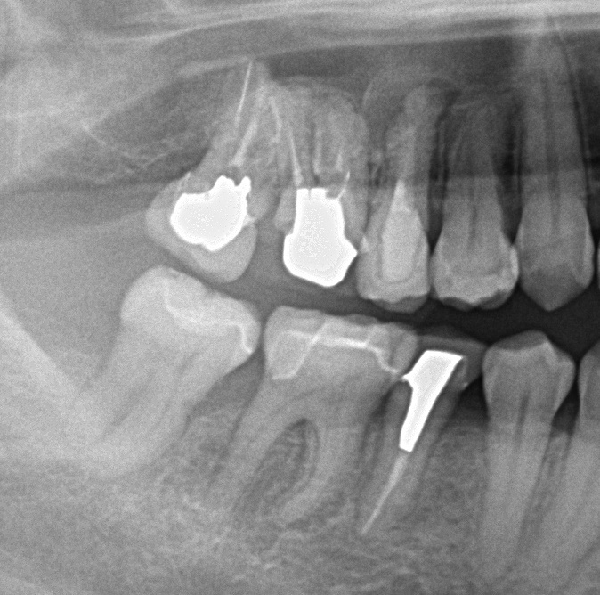 歯欠損の矯正治療後口内写真NO.94