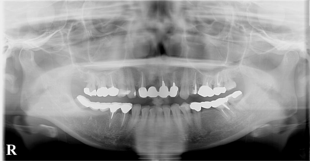 歯欠損の矯正治療前口内写真NO.95