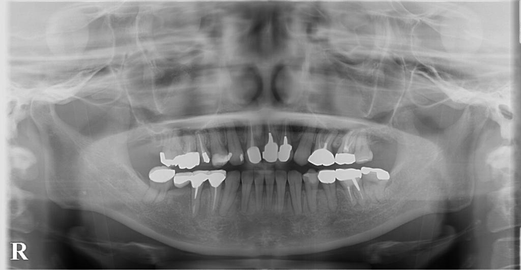 歯欠損の矯正治療後口内写真NO.95