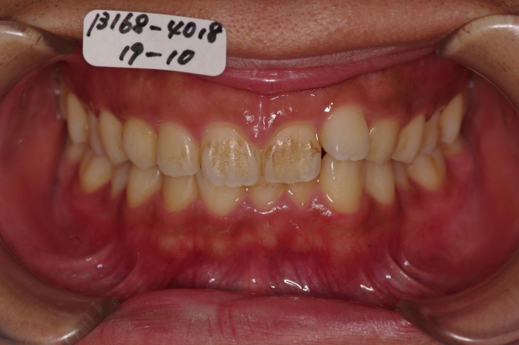 歯欠損の矯正治療前口内写真NO.96