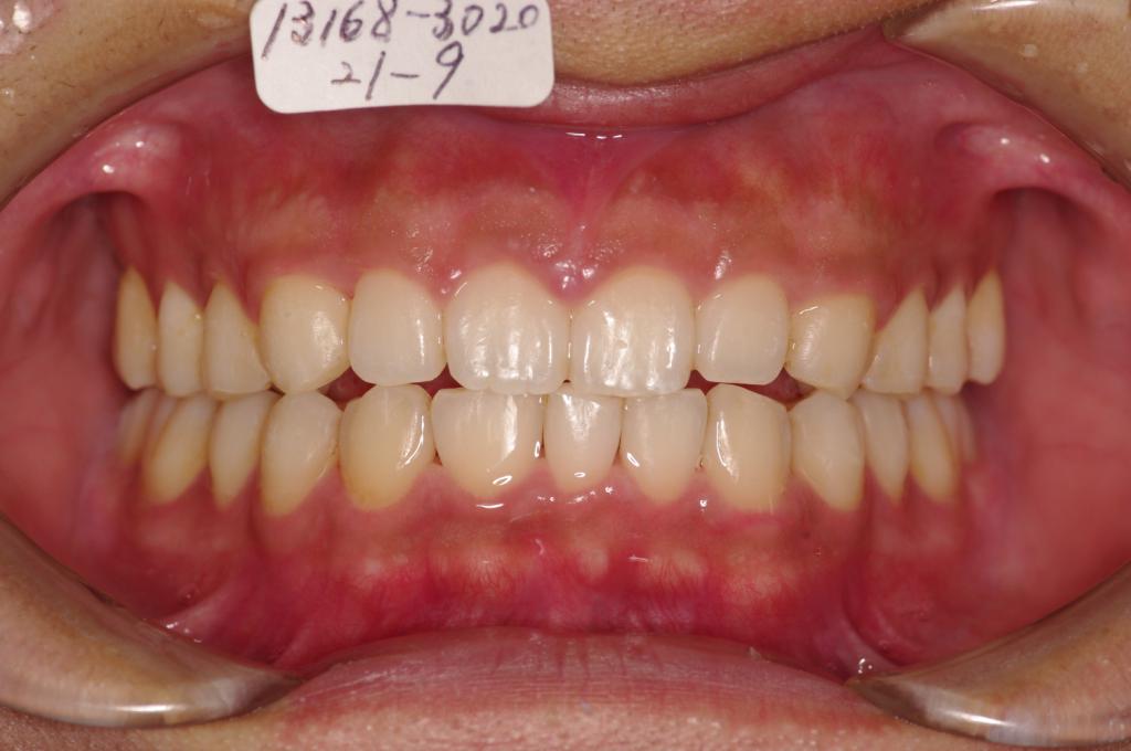 歯欠損の矯正治療後口内写真NO.96