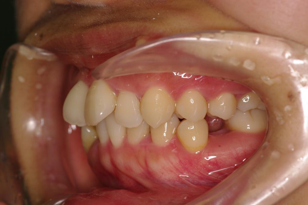 歯欠損の矯正治療前口内写真NO.97
