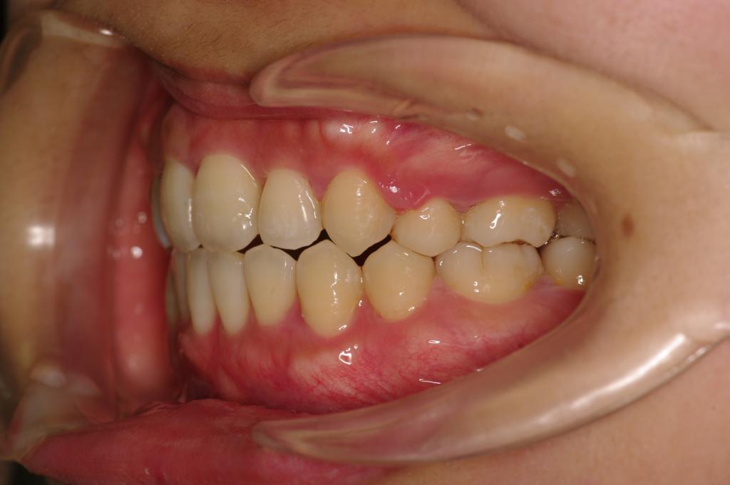 歯欠損の矯正治療後口内写真NO.97