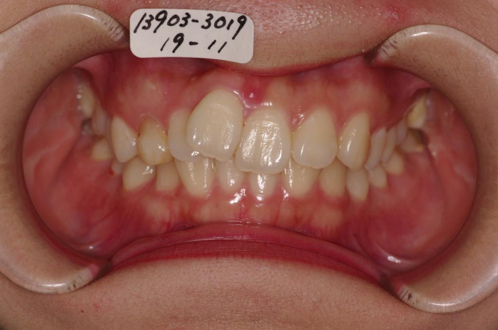 歯欠損の矯正治療前口内写真NO.98
