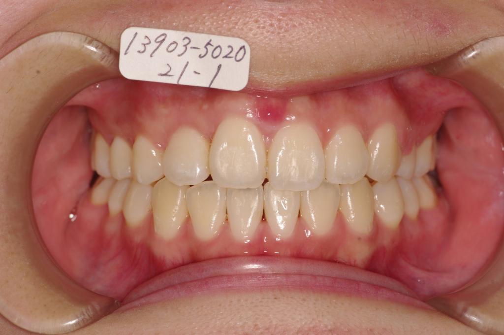 歯欠損の矯正治療後口内写真NO.98