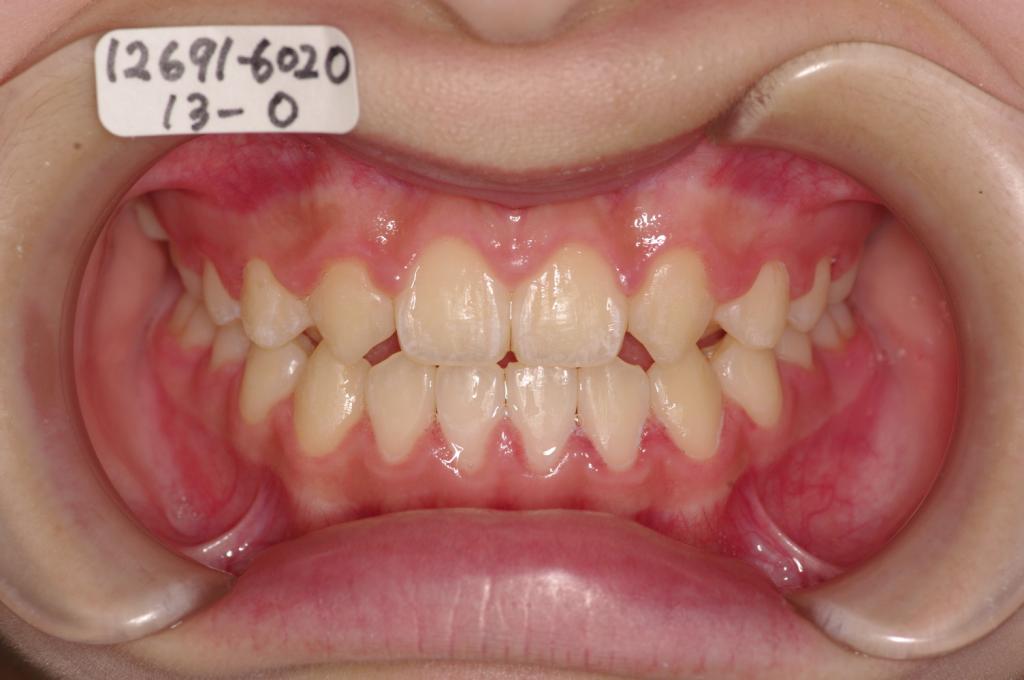 歯欠損の矯正治療後口内写真NO.99