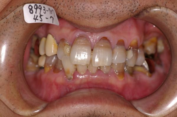 歯周病を伴った矯正治療前口内写真NO.10