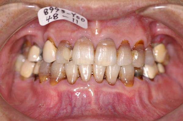 歯周病を伴った矯正治療後口内写真NO.10
