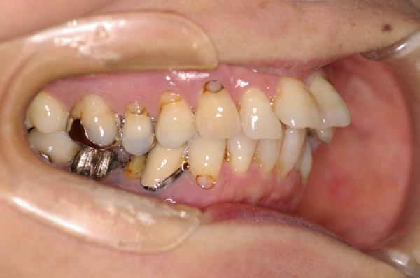 歯周病を伴った矯正治療前口内写真NO.11