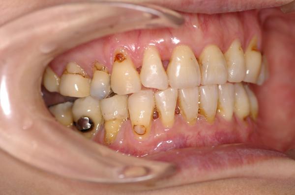 歯周病を伴った矯正治療後口内写真NO.11