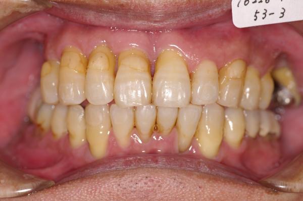 歯周病を伴った矯正治療後口内写真NO.12