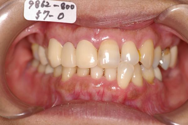 歯周病を伴った矯正治療前口内写真NO.13