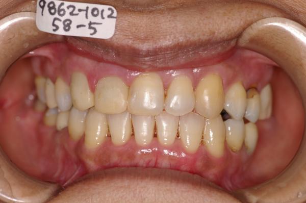 歯周病を伴った矯正治療後口内写真NO.13