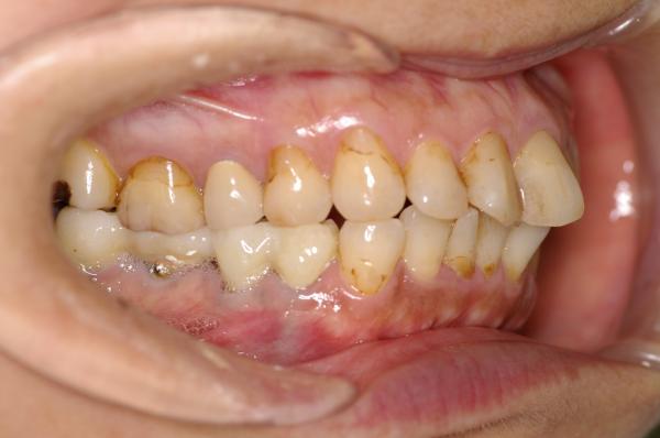 歯周病を伴った矯正治療前口内写真NO.14