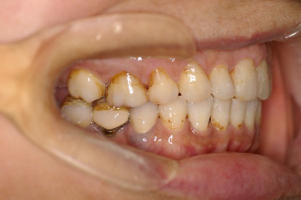 歯周病を伴った矯正治療後口内写真NO.14
