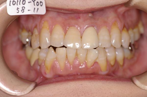 歯周病を伴った矯正治療前口内写真NO.15