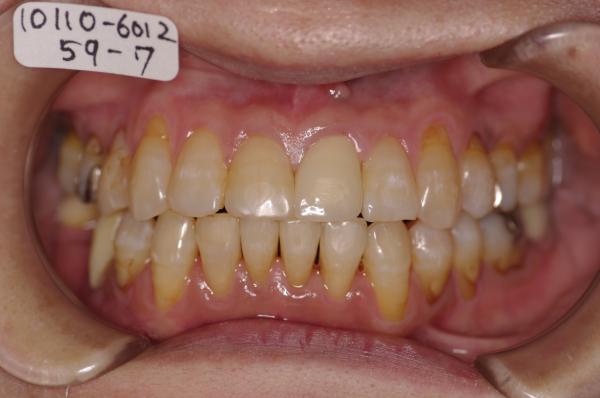 歯周病を伴った矯正治療後口内写真NO.15