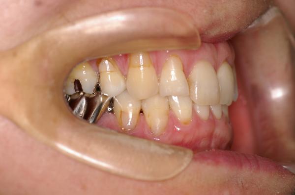 歯周病を伴った矯正治療前口内写真NO.16
